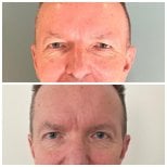 Résultats avant et après blépharoplastie chez Soraca Med, correction des paupières rajeunissante