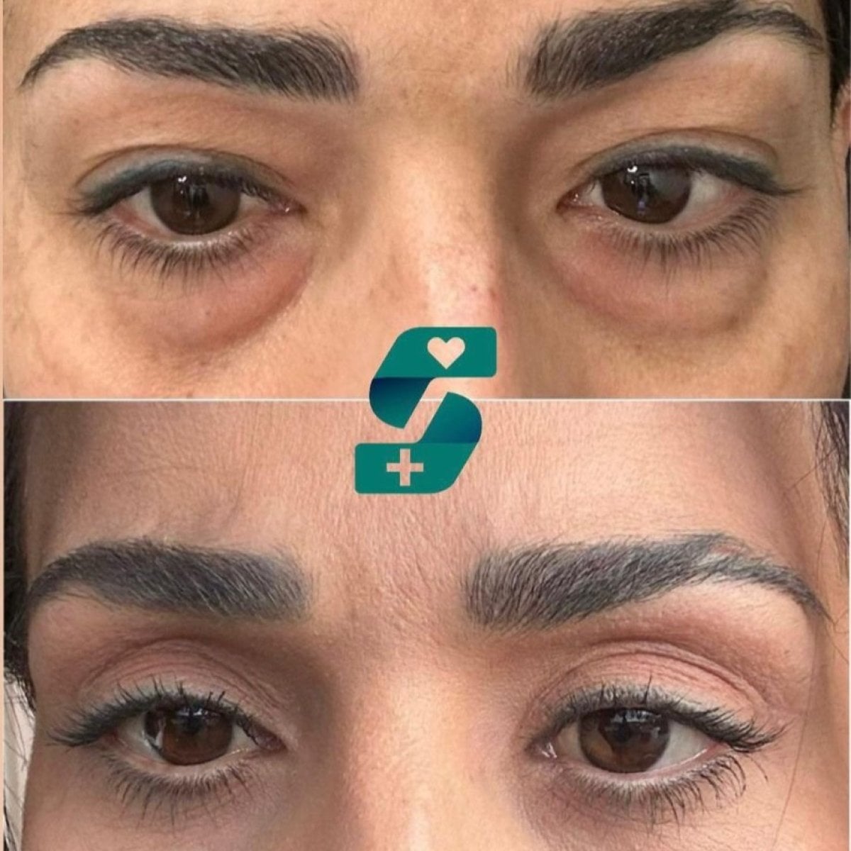 Resultados de blefaroplastia antes y después en Soraca Med, corrección natural de párpados