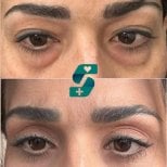 Résultats avant/après blépharoplastie chez Soraca Med, correction naturelle des paupières