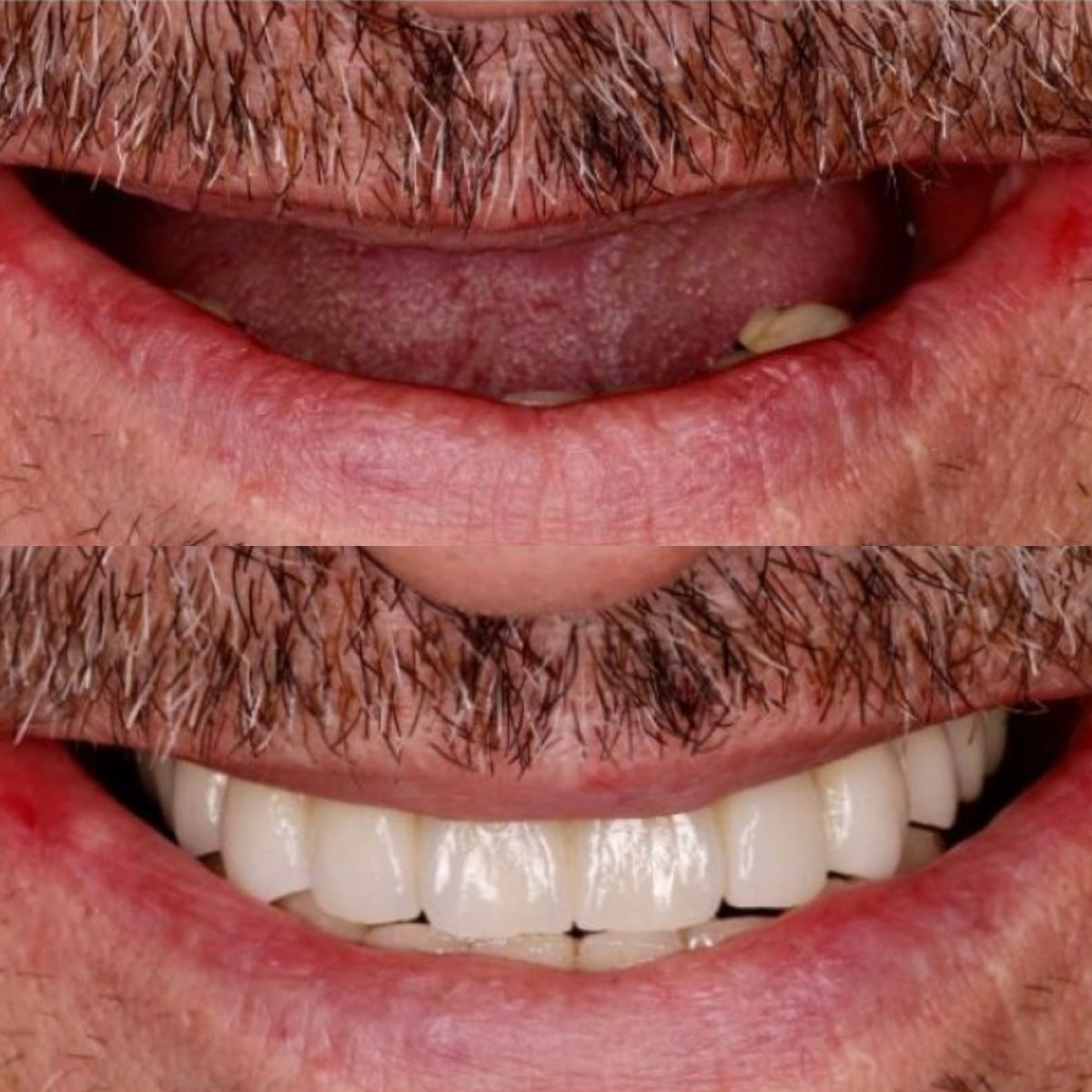Resultado antes y después de implantes All-on-4 en BMC Dental Klinik, sonrisa restaurada