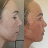 Vorher-nachher-Ergebnis Brauenlifting bei Dr. Safa Manav Clinic, sichtbare Stirnverbesserung