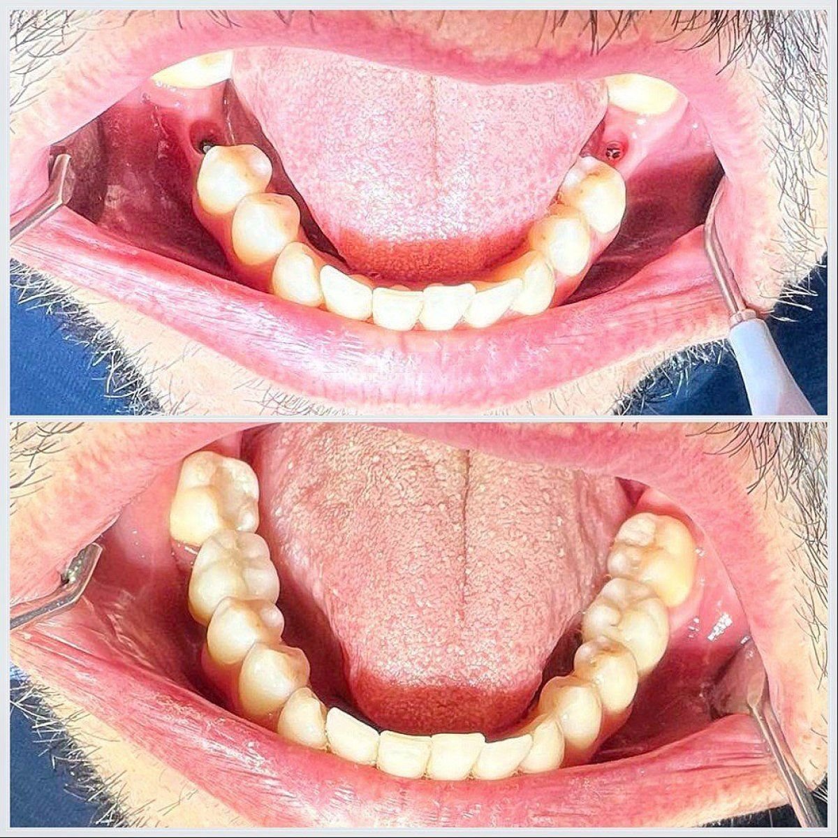 Resultados antes y después de implantes dentales en Smile Centrum, molares inferiores restaurados