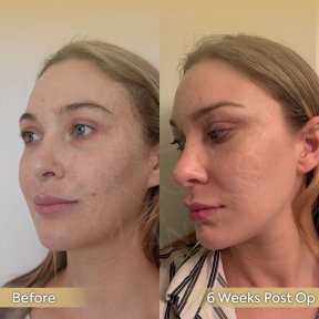 Vorher-nachher-Ergebnis Brauenlifting bei Dr. Safa Manav Clinic, sichtbare Stirnstraffung