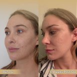 Vorher-nachher-Ergebnis Brauenlifting bei Dr. Safa Manav Clinic, sichtbare Stirnstraffung