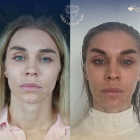 Vorher-nachher-Ergebnis Brauenlifting bei Dr. Safa Manav Clinic, sichtbare Brauenanhebung