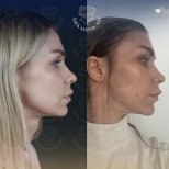 Vorher-nachher-Ergebnis Brauenlifting bei Dr. Safa Manav Clinic, sichtbare Stirnstraffung