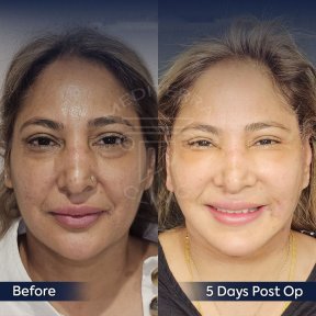 Before and after brow lift results at Dr. Safa Manav Clinic, visible forehead lift improvement