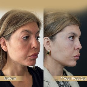 Brow Lift Vorher-Nachher-Ergebnis bei Dr. Safa Manav Clinic, sichtbare Stirnanhebung