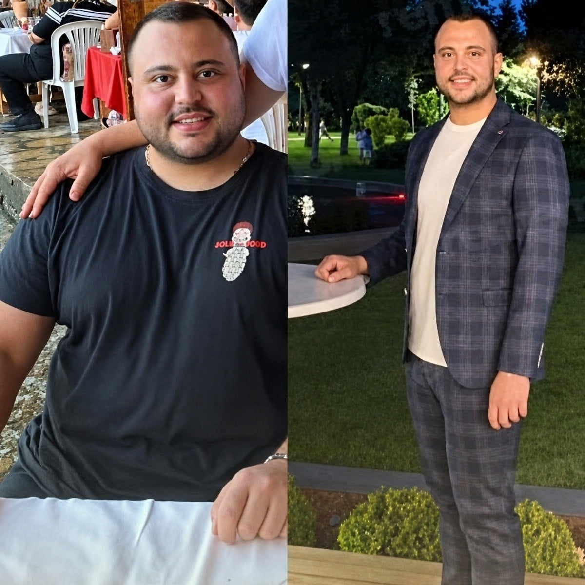 Antes y después de manga gástrica en Memorial Göztepe Hospital, resultado visible de pérdida de peso