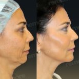 Vorher-nachher-Ergebnis Facelift bei Memorial Göztepe Hospital, sichtbare Verjüngung