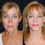 Facelift Vorher-Nachher-Ergebnisse im Memorial Göztepe Hospital, sichtbare Verjüngung