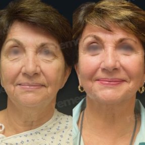 Facelift Vorher-Nachher-Ergebnisse im Memorial Göztepe Hospital, sichtbare Verjüngung