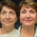 Facelift Vorher-Nachher-Ergebnisse im Memorial Göztepe Hospital, sichtbare Verjüngung
