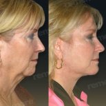 Facelift Vorher-Nachher-Ergebnisse bei Memorial Göztepe Hospital, sichtbare Verjüngung