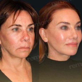Facelift Vorher-Nachher-Ergebnisse im Memorial Göztepe Hospital, sichtbare Verjüngung