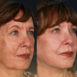 Facelift Vorher-Nachher-Ergebnisse im Memorial Göztepe Hospital, sichtbare Verjüngung