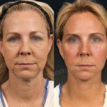 Facelift Vorher-Nachher-Ergebnisse in Memorial Göztepe Hospital, sichtbare Verjüngung
