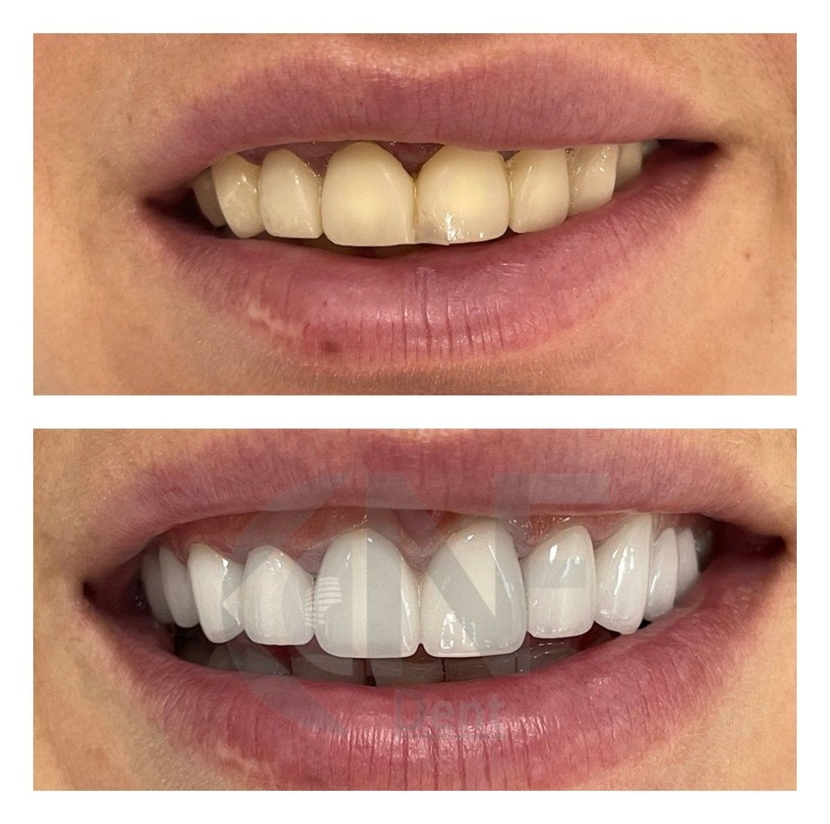 Resultado antes y después de carillas sin tallado en Nifa Dent International, transformación de sonrisa