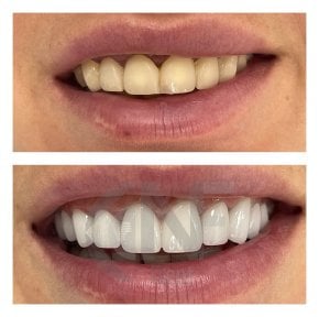 Vorher-nachher-Ergebnis No-Prep-Veneers bei Nifa Dent International, Lächeln-Transformation