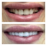 Vorher-nachher-Ergebnis No-Prep-Veneers bei Nifa Dent International, Lächeln-Transformation