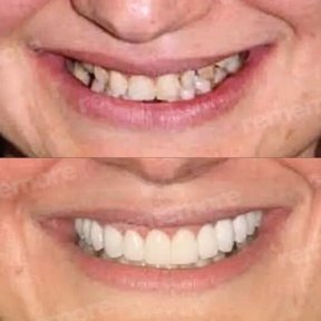 Vorher-nachher-Ergebnis No-Prep-Veneers bei Memorial Bahçelievler Hospital, Lächeln-Makeover