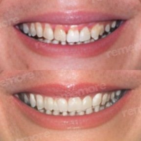 Vorher-nachher-Ergebnis No-Prep-Veneers bei Memorial Bahçelievler Hospital, Lächeln-Makeover