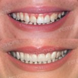 Vorher-nachher-Ergebnis No-Prep-Veneers bei Memorial Bahçelievler Hospital, Lächeln-Makeover