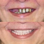 Vorher-nachher-Ergebnis No-Prep-Veneers bei Memorial Bahçelievler Hospital, Lächeln-Transformation