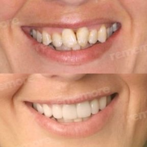 Vorher-nachher-Ergebnis No-Prep-Veneers bei Memorial Bahçelievler Hospital, Lächeln