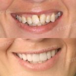 Vorher-nachher-Ergebnis No-Prep-Veneers bei Memorial Bahçelievler Hospital, Lächeln