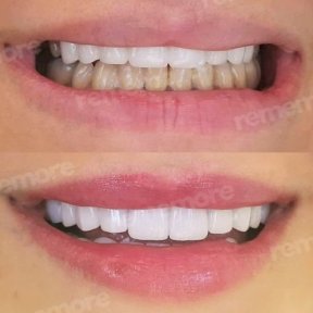Vorher-nachher-Ergebnis No-Prep-Veneers bei Memorial Bahçelievler Hospital, neues Lächeln