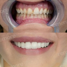 Vorher-nachher-Ergebnis No-Prep-Veneers bei Memorial Bahçelievler Hospital, neues Lächeln