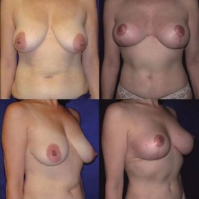 Before and after breast implants with lift at Memorial Ataşehir Hospital, enhanced breast shape result