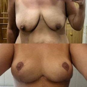 Before and after breast implants with lift at Memorial Ataşehir Hospital, enhanced breast shape result