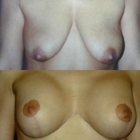 Before and after breast implants with lift results at Memorial Ataşehir Hospital, improved shape