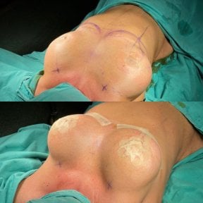 Before and after breast lift results at Dr. MED, improved breast contour and firmness