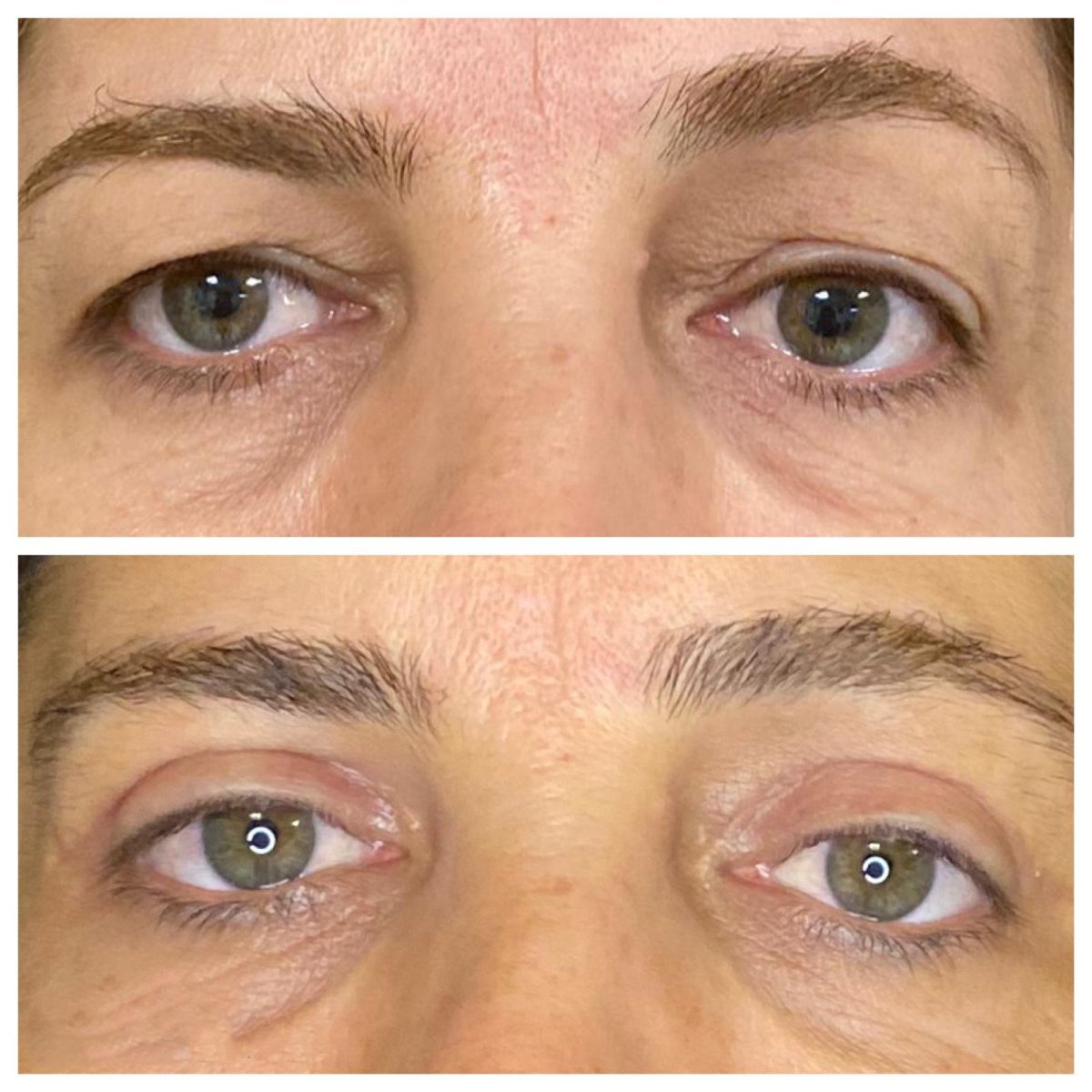 Resultados de blefaroplastia antes y después en Dunyagoz Eye Hospital Antalya, corrección de párpados