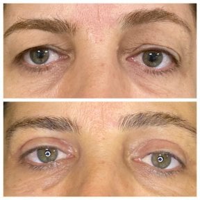 Résultats avant/après blépharoplastie à Dunyagoz Eye Hospital Antalya, correction des paupières