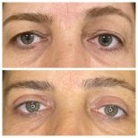 Résultats avant/après blépharoplastie à Dunyagoz Eye Hospital Antalya, correction des paupières
