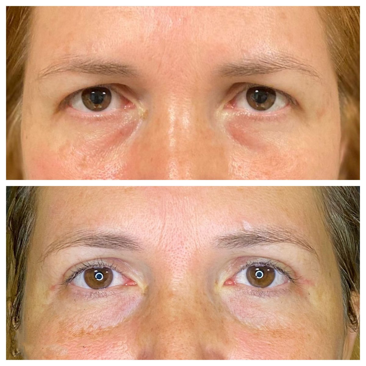 Resultados de blefaroplastia antes y después en Dunyagoz Eye Hospital Antalya, corrección de párpados