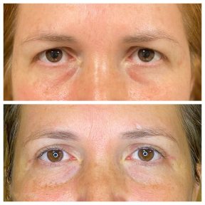 Résultats avant/après blépharoplastie à Dunyagoz Eye Hospital Antalya, correction des paupières