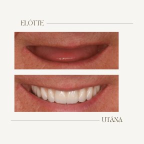 Vorher-nachher-Ergebnis Zahnimplantate bei BMC Dental Klinik, wiederhergestelltes Lächeln