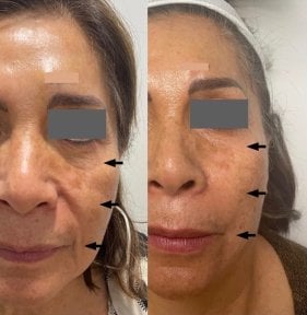 Before and after fillers injection at Dr. Lavalle's Private Practice, facial rejuvenation result