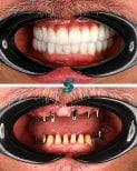 Before and after dental implant results at Soraca Med – restored smile and improved teeth