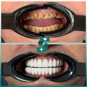 Before and after dental implant results at Soraca Med – restored white smile transformation
