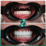 Before and after dental implant results at Soraca Med, improved smile and restored teeth