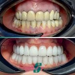 Before and after dental implant results at Soraca Med – restored white smile transformation