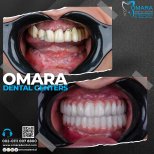 Résultat avant/après implants All-on-6 chez Omara Dental Centers, restauration complète du sourire