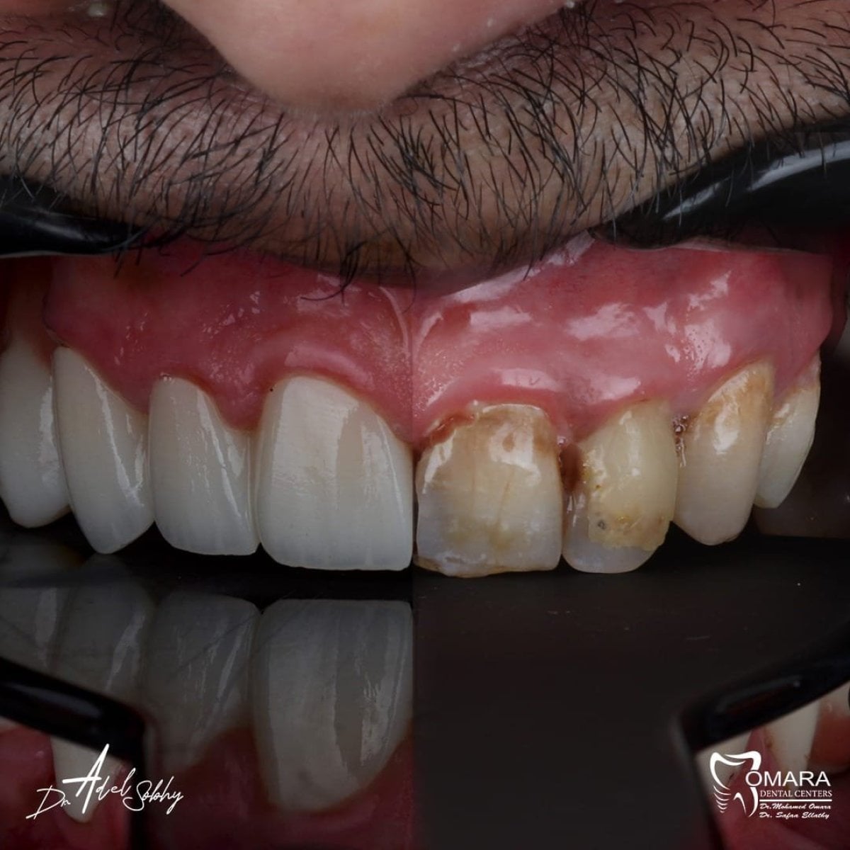 نتائج قبل وبعد تركيب تيجان الزركونيا في Omara Dental Centers، استعادة واضحة للابتسامة