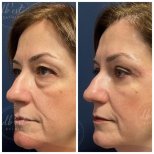 Vorher-nachher-Ergebnis der Blepharoplastik bei Db'est Clinic, Lidkorrektur für jüngeres Aussehen